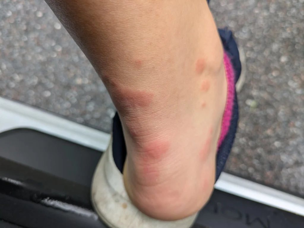 Tag-8 - Die Mückenstiche der letzten Tage